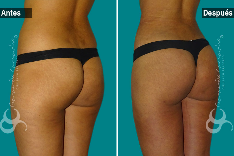 Resultados naturales de gluteoplastia en Bogotá